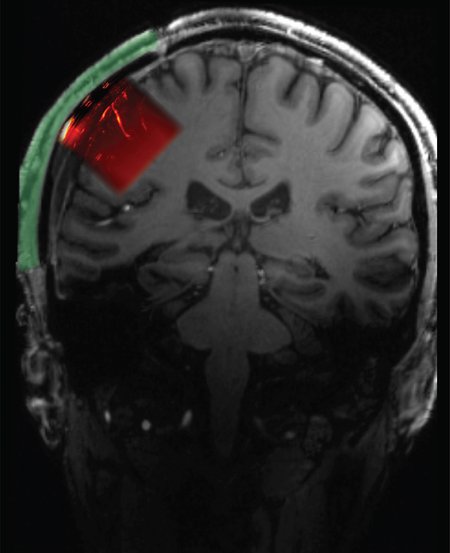 Drawing of human head from the back showing skull, a cranial prosthetic on the left side in green, and a red rectangle showing the area of the brain that can be imaged by ultrasound through the prosthetic.