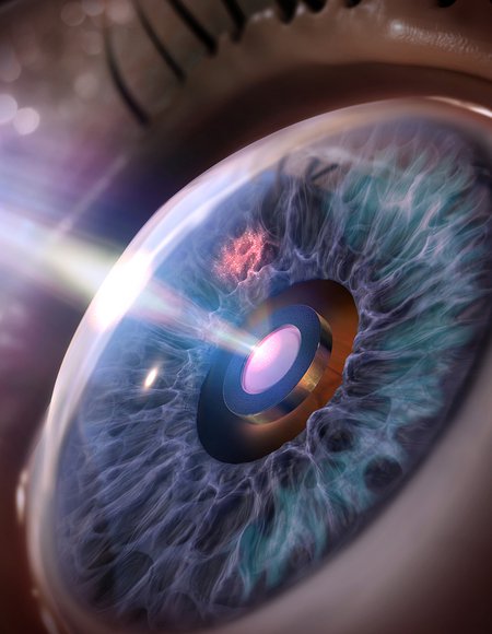 Extraocular Implant